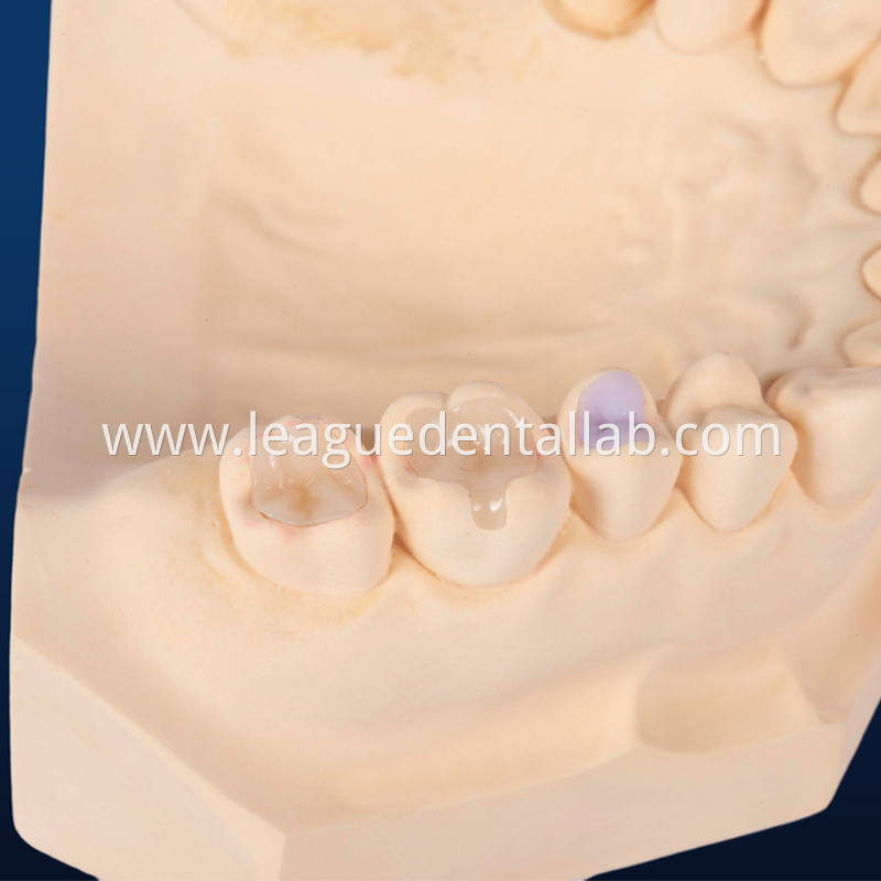 Dental Implant Crown, Dental Implant Zirconia crown,Dental Implant Emax crown,Dental Implant Bridge